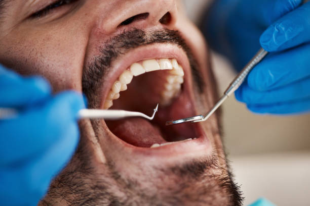 Best Emergency Treatment for Dental Infections or Abscesses in Wellsburg, WV